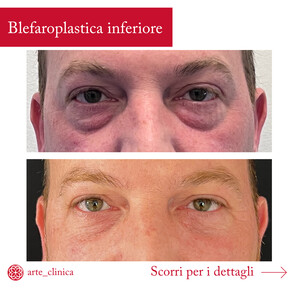 Image of Eyelid surgery