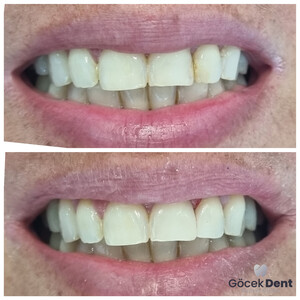 Image of Aesthetic dentistry - Göcek Dent