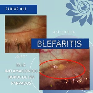 Image of Blefaritis