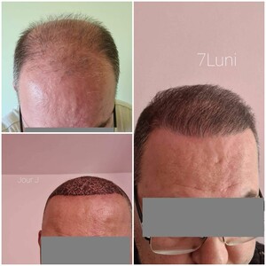 Image of Hair transplantation - Bendis Clinic