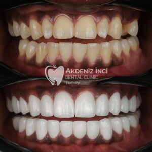 Image of Smile makeover - Akdeniz Inci Dental Clinic