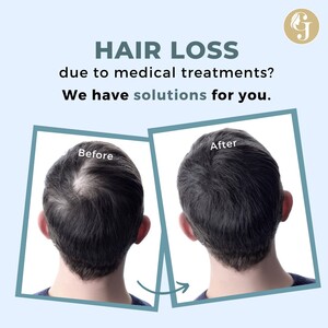 Image of Glojas Hair Transplant Malaysia Gallery 3