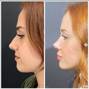 Image of Bursa Rhinoplasty - Op. Dr. Ferit Bayakır Gallery 3