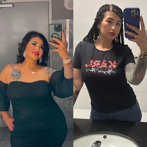 Image of Before and after bariatric surgery