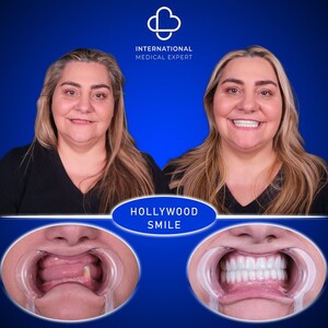 Image of Hollywood Smile