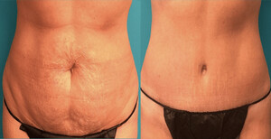 Image of Tummy Tuck