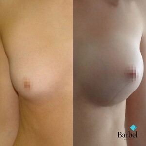 Image of Breast Implant - Barbel Polyclinic