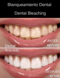 Image of Dental bleaching