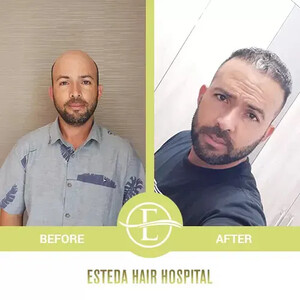 Image of Esteda Hair Hospital - Hair Transplant Turkey Gallery 1