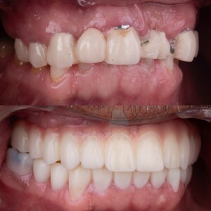 Image of Dental treatment before and after