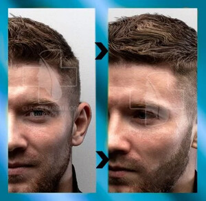 Image of Hair transplant - Barbatilor Clinic