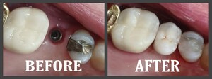 Image of Dental implants