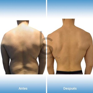 Image of Liposuction