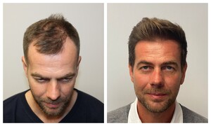 Image of Hair transplantation in Hungary