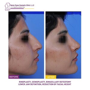 Image of Before and After Rhinoplasty