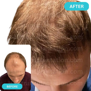 Image of Hairtransplantation.com Gallery 1