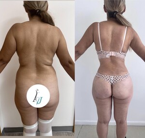 Image of Liposuction