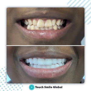 Image of Hollywood smile