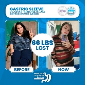 Image of Gastric sleeve surgery