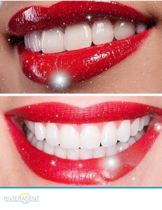 Image of Hollywood Smile