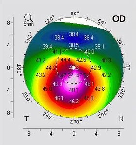 Image of Keratoconus - Opto Center