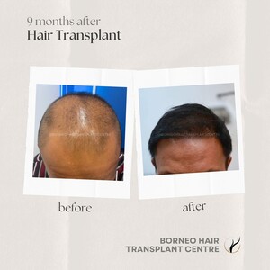 Image of Borneo Hair Transplant Centre Gallery 2