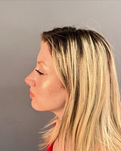 Image of After rhinoplasty