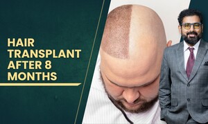 Image of Hair transplantation