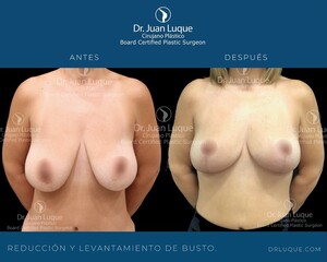 Image of Breast reduction and lift