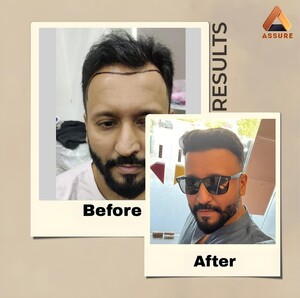 Image of Hair Transplantation Before and After