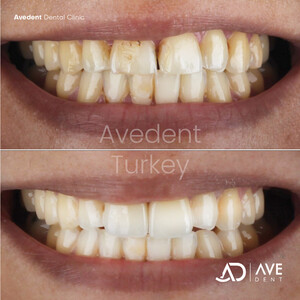 Image of Avedent Dental Clinic Turkey Gallery 0