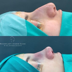 Image of Rhinoplasty Athens Clinic by Dimitris Louloudis Gallery 2