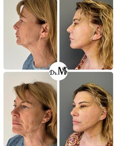 Image of Face lift, neck lift and upper eyelid surgery