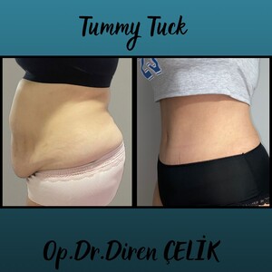 Image of Tummy tuck