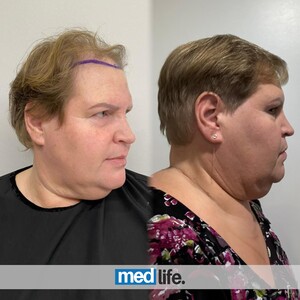 Image of Medlife Group - Hair Transplant Gallery 1