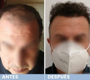 Image of before and after hair transplant