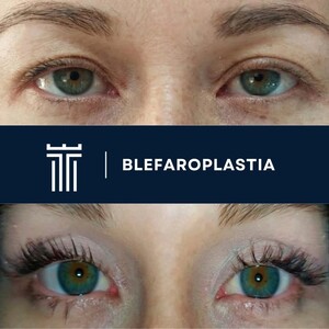 Image of Eyelid surgery