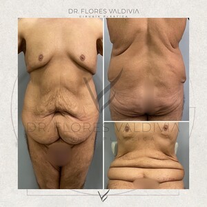 Image of Body lift before and after