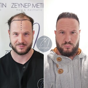 Image of  Hair transplant before and after