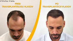 Image of Hair transplant - Phaeyde Clinic