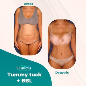 Image of Tummy Tuck + BBL