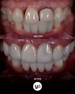 Image of Veneers and Dental Bridges