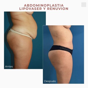 Image of Tummy tuck and VASER Lipo