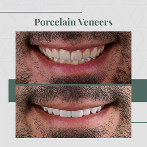 Image of Porcelain Veneers