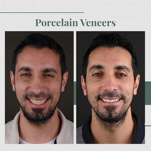 Image of Before and after procelain veneers