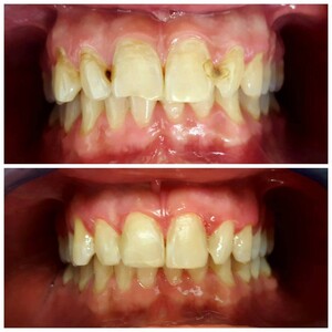 Image of Composite bonding