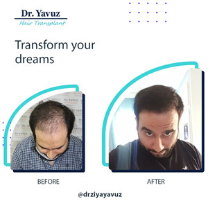 Image of Doctor Ziya Yavuz Hair Transplant Clinic Gallery 2