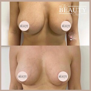 Image of Breast Implant - The Beauty Clinic