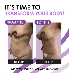 Image of Mommy Makeover with Implants