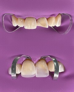 Image of Dental crowns - Apolodor Dental Clinic